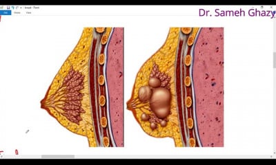 امراض الثدى breast diseases