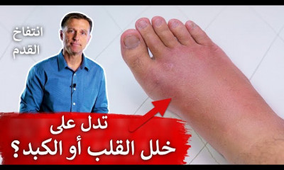 ذمة وانتفاخ القدم اليمنى