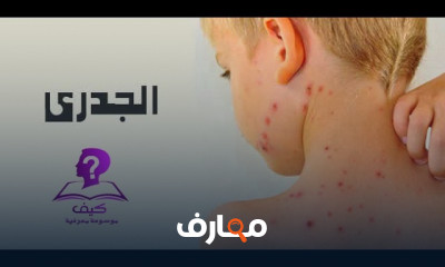 مرض الجدري