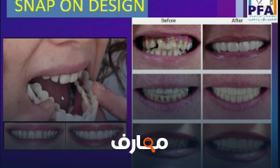 شعبة فني أسنان