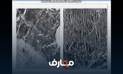 أمراض اللثة اكتشف كيفية التغلب على أمراض اللثة