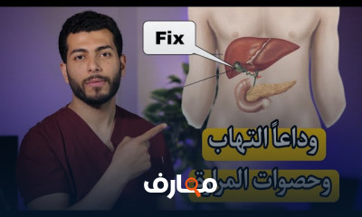 علاج التهاب وحصوات المرارة بدون جراحه