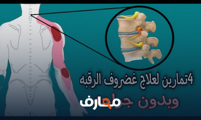 علاج انزلاق غضروف الرقبة بدون جراحة
