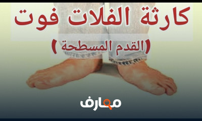 علاج الفلات فوت أو القدم المسطحه بالتمارين