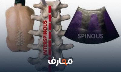 علاج آلام بطانه الرحم المهاجره وآلام الحوض المزمنه