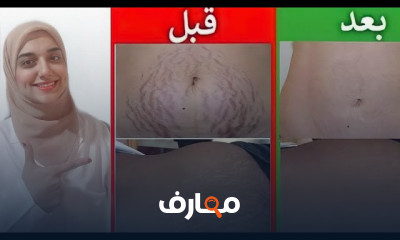 علاج الخطوط الحمراء والبيضاء في الجسم نهائيا