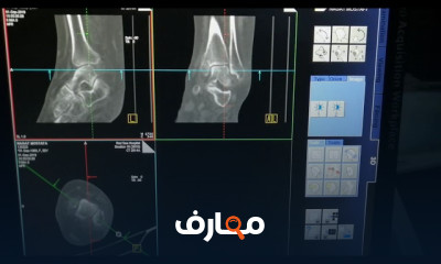 اشعة مقطعيه بالتفصيل