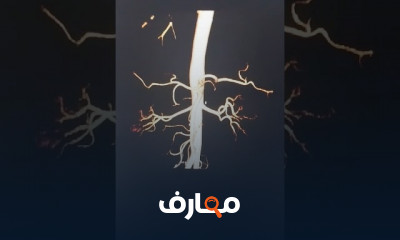 الأشعة المقطعية للشرايين والأوردة