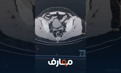 تصوير الأشعة المقطعية بدون صبغة