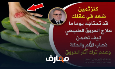 معالجة الحروق طبيعيا