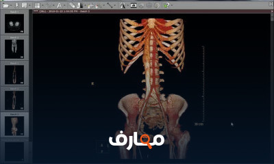 تصوير الأوعية التاجية بالفحص المقطعي المحوسب CT