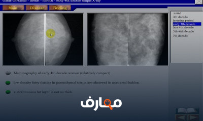 Breast Ultrasound سونار الثدي