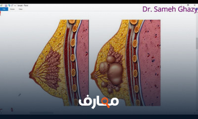 امراض الثدى breast diseases