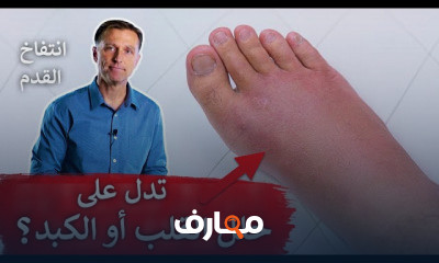 ذمة وانتفاخ القدم اليمنى