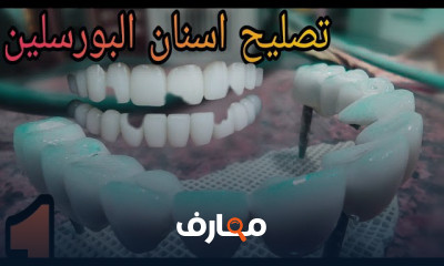 تصليح الأسنان البورسلين