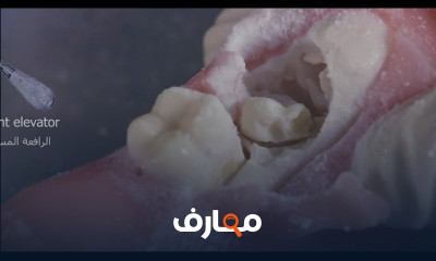 خلع ضرس العقل المدفون