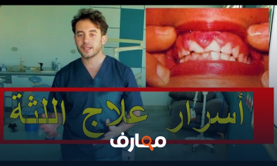 أسباب التهاب اللثة
