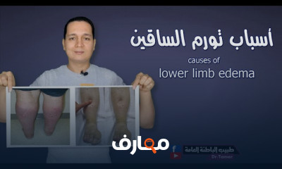 أسباب تورم الساقين