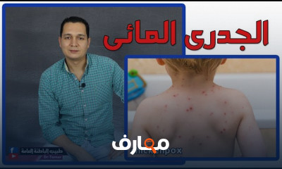 أسباب الجدرى المائى