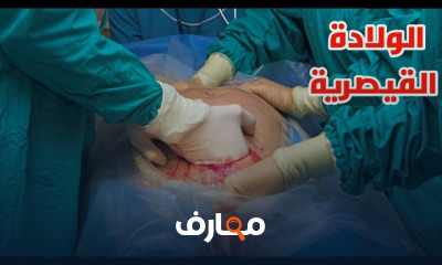 طريقه تركيب تقويم الأسنان