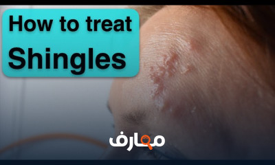 طرق الوقاية من الهربس النطاقي