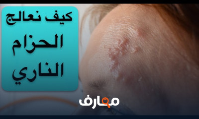 طرق علاج الزونا أو الحزام الناري