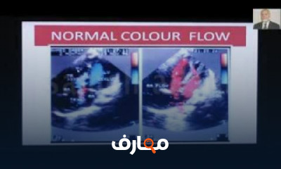أمراض صمامات القلب
