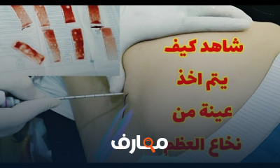 خزعة نخاع العظم