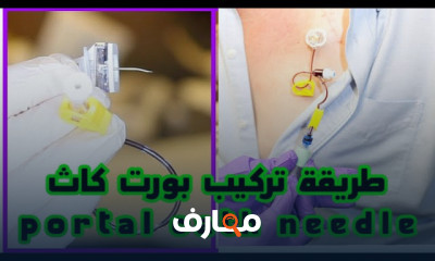 طريقة تركيب إبرة البورت كاث