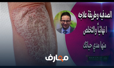 أسباب مرض الصدفيه
