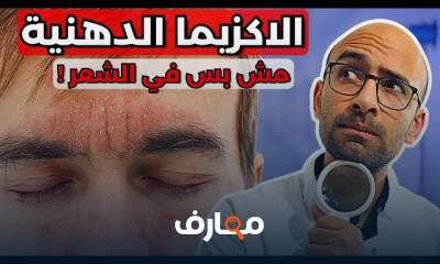 علاج قشرة الشعر