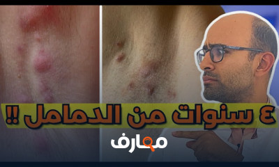 أسباب التهاب الغدد العرقية