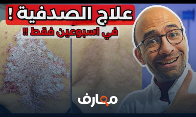 أسباب وعلاج الصدفية