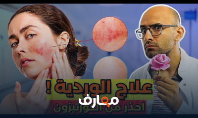 طرق علاج الوردية