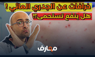 أسباب وعلاج الجدري المائي