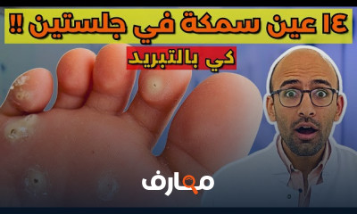 أسباب عين السمكة والسنط