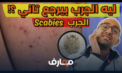 علاج الجرب Scabies