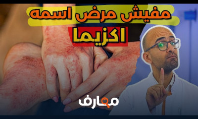 أسباب الأكزيما وأنواعها