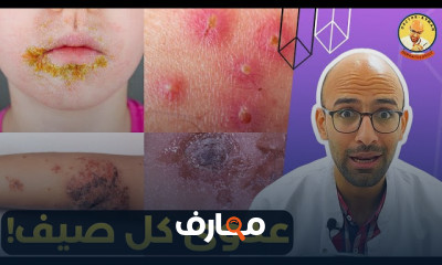 أسباب التينيا الملونة