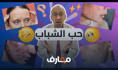 أسباب وعلاج حب الشباب