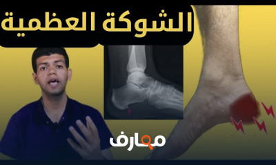 تمارين التهاب اللفافة الأخمصية