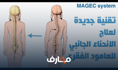 تمارين علاج تقوس الظهر