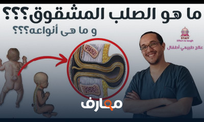 أسباب الصلب المشقوق