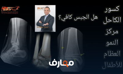 كسور الكوع في الأطفال