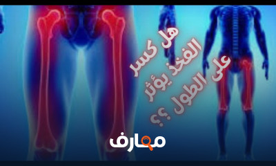 علاج كسر العظام عند الاطفال