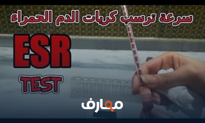 أعراض وأسباب سرعة الترسيب