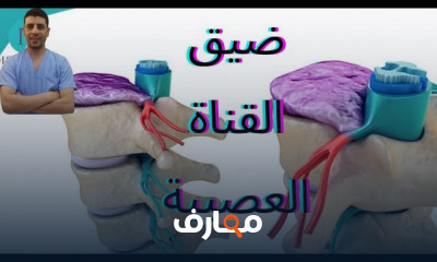 أسباب وأعراض هشاشة العظام