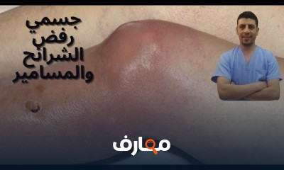 علاج الالتهاب الصديدي للمعادن