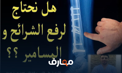 علاج كسور العظام لدى الأطفال