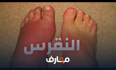 علاج النقرس